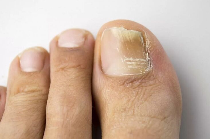 Mycosis van de nagel op het been