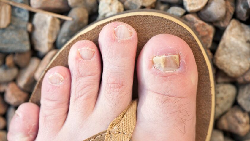 Onychomycosis van de nagels